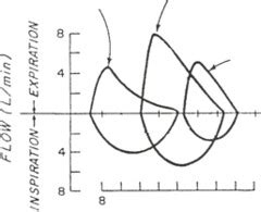 Pulmonary Function Tests And Flow Volume Loops Quizlet