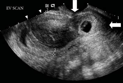 Sonographic Assessment Of Ectopic Pregnancy Flashcards Quizlet