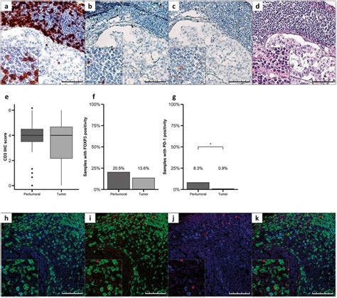 Characterization Of The Immune Cell Infiltrate In GEP NETs A D