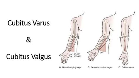 Cubitus valgus varus | PPT