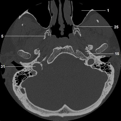 Cranial Bone Anatomy Ct Axial