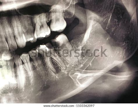 7 Mandibular Lesions Images, Stock Photos & Vectors | Shutterstock