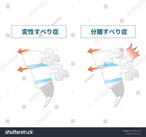 Illustration Spondylolisthesis Symptoms Translation How Separation