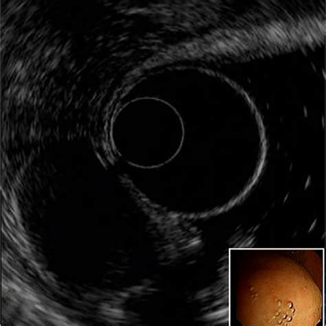 Endoscopic Ultrasonography Showed A Hypoechoic Mass In The Fourth Layer Download Scientific