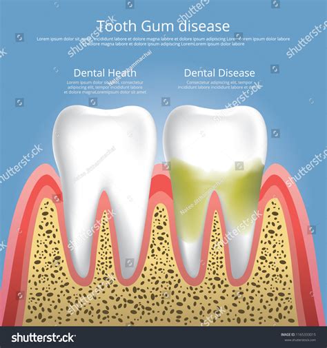 Human Teeth Stages Of Gum Disease Vector Royalty Free Stock Vector