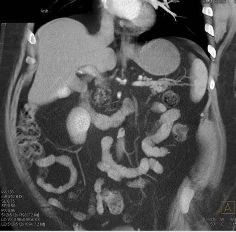 Vascular Metastases To The Liver Bone And Muscle From Renal Cell