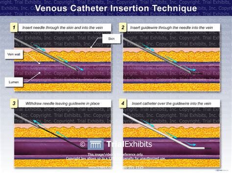 Venous Catheter Insertion Technique - Trial Exhibits Inc.