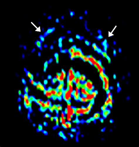 Motion Artifacts In Asl Motion Artifacts Result In A Ring Pattern On