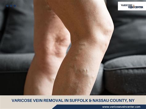 Deep Vein Thrombosis Treatment — Port Jefferson Ny By Varicose Vein Center May 2024 Medium