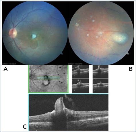 Scielo Brasil Pars Plana Vitrectomy And Visual Stimulation For