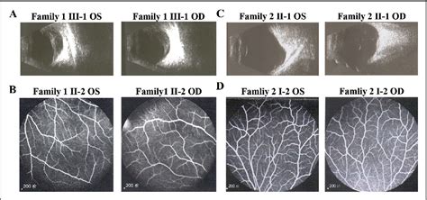 Figure 1 From Whole Exome Sequencing Reveals Novel NDP Variants In X