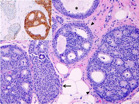 Pathology Outlines Lobular Carcinoma In Situ LCIS Classic