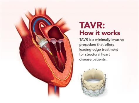 Understanding Heart Surgery St Clair Health