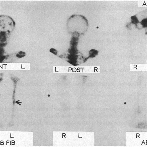 Pdf Periostitis In Secondary Syphilis A Place For Bone Scintigraphy