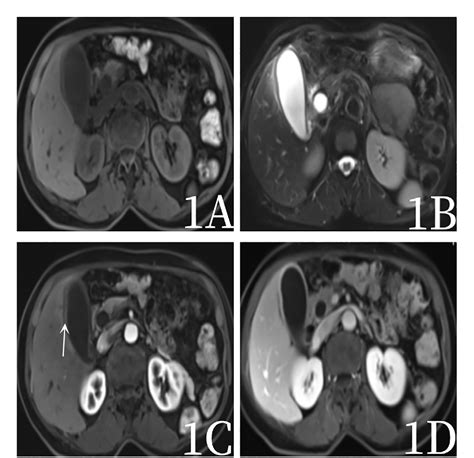 Figure From Application Of F Fdg Pet Ct Imaging In Gallbladder