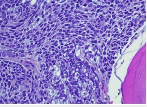 Bone Marrow Core Biopsy Showing Nuclear Detail Of Finely Stippled