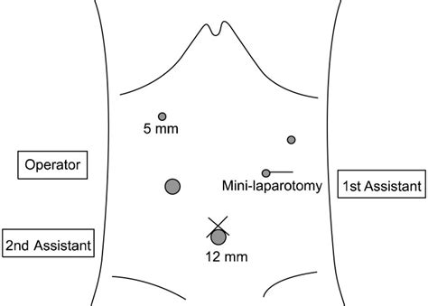 Ports Placement For Laparoscopy Assisted Total Gastrectomy With Download Scientific Diagram