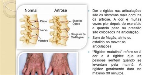 Quais Os Sintomas Da Artrose Pacientes Do Dr M Rcio Silveira