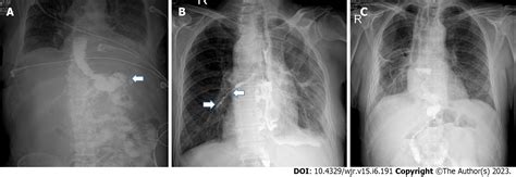 Role Of Contrast Enhanced Serial Spot Abdominal X Rays In Perioperative