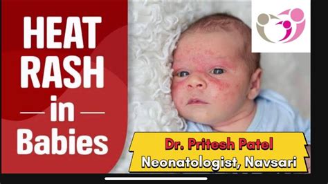 What Is Heat Rash Prickly Heat Youtube