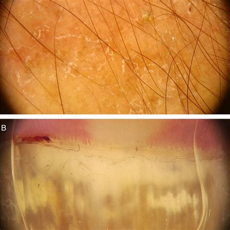 Dermoscopic Image Of Tinea Nigra Demonstrating Diffuse Linear Blackened Download Scientific