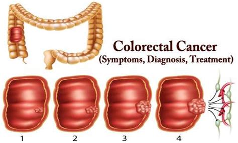 Colorectal Cancer (Symptoms, Diagnosis, Treatment) - Assignment Point