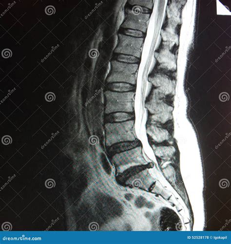 Mri Of Lumbar Spine Stenosis Stock Photo Image Of Positions Legs