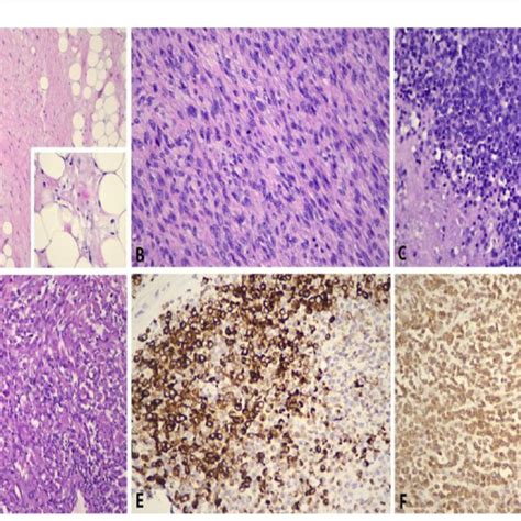 Histopathological Features Of Paratesticular Dedifferentiated