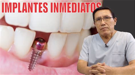 Implante Dental Inmediato En Una Sesi N Reemplazo Dental En Dr