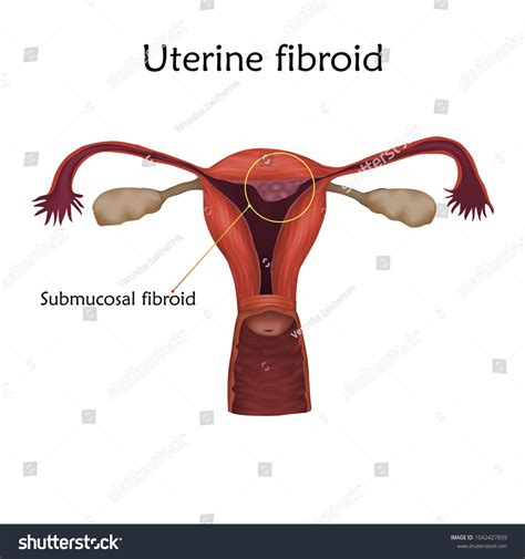 Uterine Fibroid Human Realistic Uterus Anatomy Stock Vektorgrafik