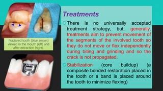 Cracked Tooth Syndrom Ppt