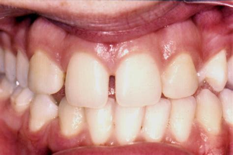 Final Appearance After Esthetic Transformation Of The Maxillary