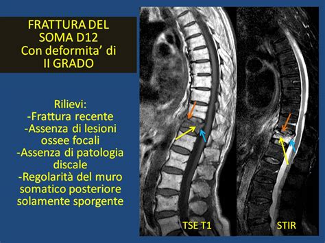 La Morfometria Vertebrale Radiologia Ortopedica