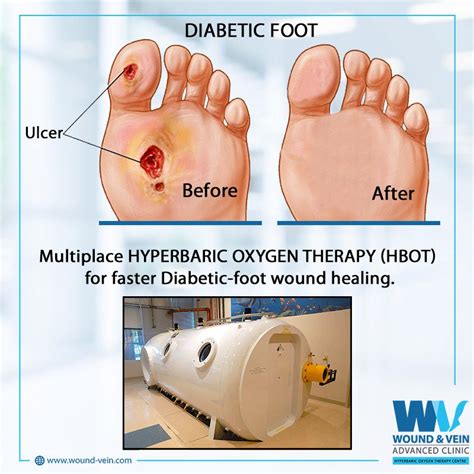 Hyperbaric Oxygen Wound Therapy