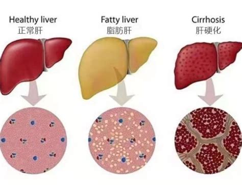 一个月内两位影视明星因肝癌去世肝脏最不喜欢几件事我们天天都在做 山东省济宁市第一人民医院