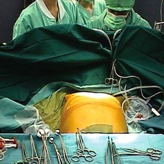 Laparotomy Vs Laparoscopy