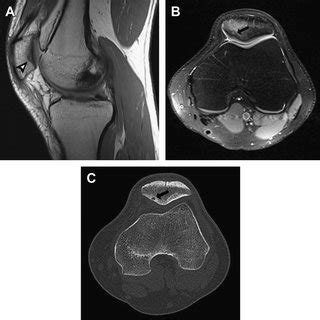 Myxoid Liposarcoma Misdiagnosed As A Popliteal Baker Cyst A