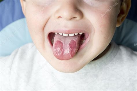 Geographic tongue disease in a child — Stock Photo © angelsimon #13904116