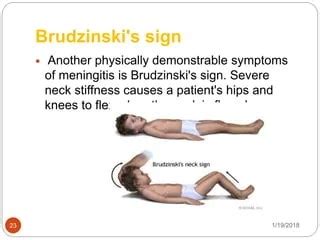 Brudzinski Sign In Meningitis - Other signs of meningitis · sudden high fever · stiff neck ...