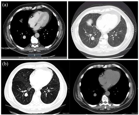 Incidental Case Of An Idiopathic Pulmonary Arterial Aneurysm