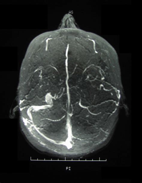 Magnetic Resonance Venogram Demonstrating Occlusion Of The Left Sigmoid