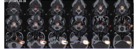 SPECT CT核素显像在咽鼓管功能的临床研究