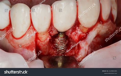 Installed Bare Dental Implant Central Tooth Stock Photo