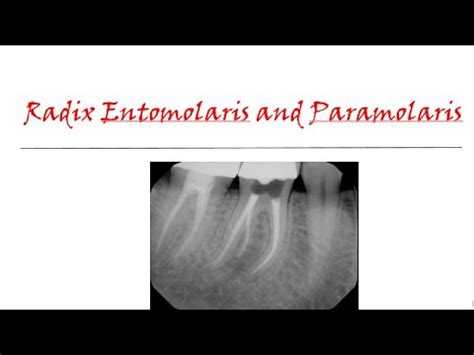 Radix Entomolaris And Paramolaris YouTube