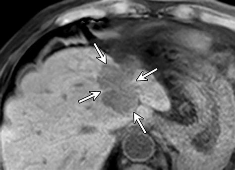 Intrahepatic Mass Forming Cholangiocarcinoma Arterial Enhancement