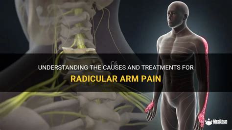 Understanding The Causes And Treatments For Radicular Arm Pain | MedShun