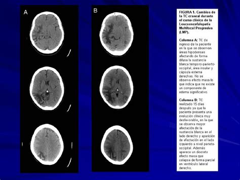 Figure From Leucoencefalopatia Multifocal Progresiva Tras Tratamiento