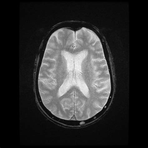 Multiple Myeloma Image