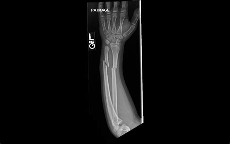 Open Forearm Fracture Treated Surgically Forearm Fracture