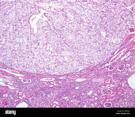 Human Kidney Light Micrograph Showing The Border Between A Renal Clear